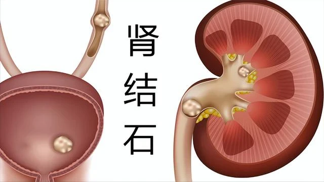 腎最怕2種「水」，可惜多數人不知道，牢記3多1少，腎臟悄悄變好