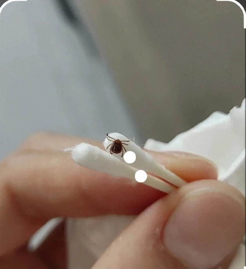 孩子脖子驚見蜱蟲！爸急用「火攻硬拔」全被媽擋下…改用網友1神招，10分鐘乾淨取出