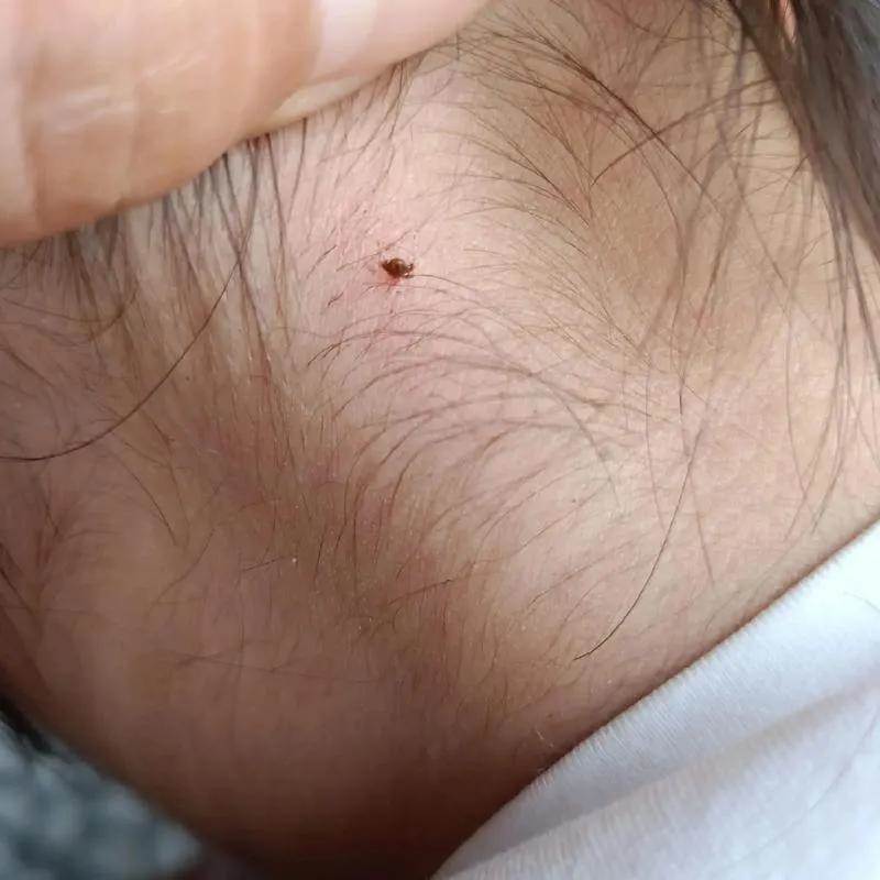 孩子脖子驚見蜱蟲！爸急用「火攻硬拔」全被媽擋下…改用網友1神招，10分鐘乾淨取出