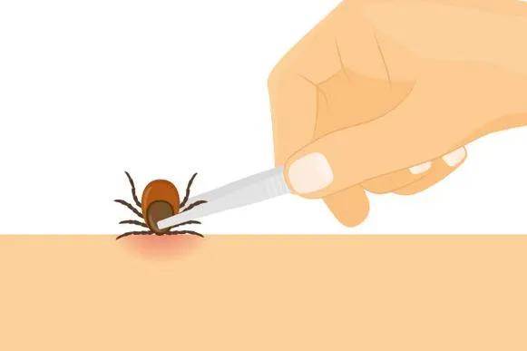 孩子脖子驚見蜱蟲！爸急用「火攻硬拔」全被媽擋下…改用網友1神招，10分鐘乾淨取出