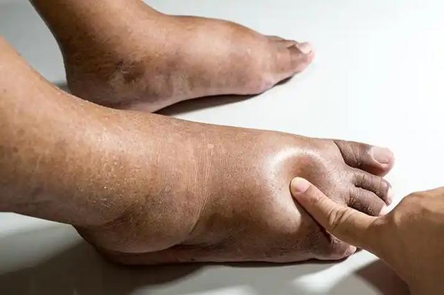 腿部是腦梗的放大鏡？醫生忠告：腿部出現這幾種表現，要儘快就醫