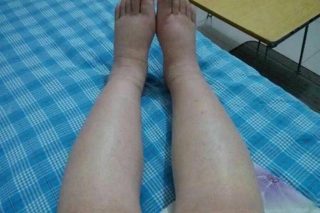 腿部是腦梗的放大鏡？醫生忠告：腿部出現這幾種表現，要儘快就醫
