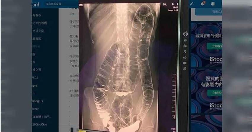 腹部全塞滿!!!  佩甄認出事了「內部長東西」：用手就能摸到