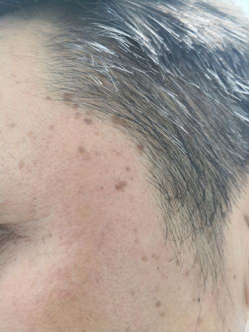 都是50歲！為何有些人皮膚上的老年斑「密密麻麻」有的卻很乾凈！醫生說出實情