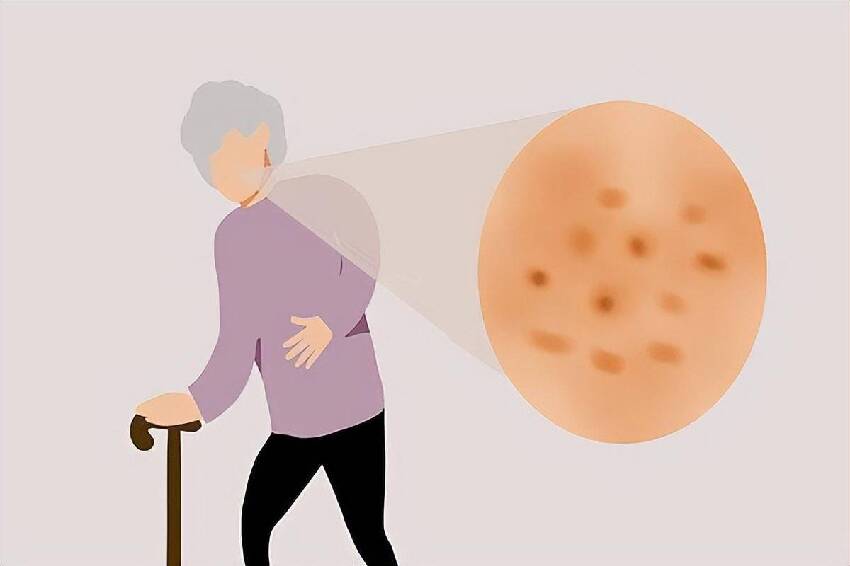 都是50歲！為何有些人皮膚上的老年斑「密密麻麻」有的卻很乾凈！醫生說出實情