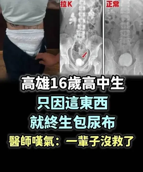 高雄16歲高中生「只因這東西就終生包尿布」！醫師嘆氣：一輩子沒救了！一定要轉出去，爸媽千萬注意孩子的舉動~