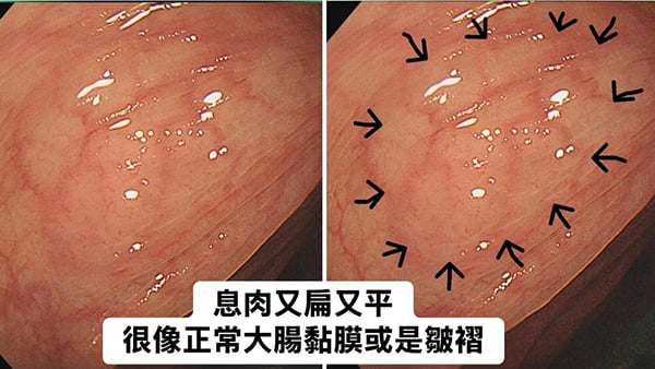 女子常胃痛脹氣 大腸鏡一照 竟有20顆息肉！