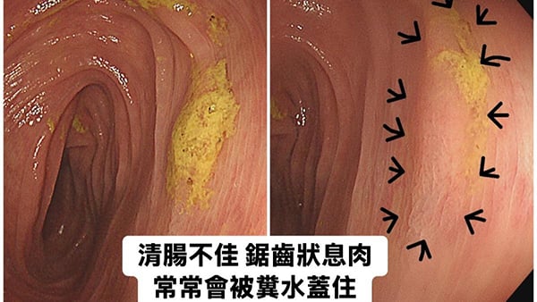 女子常胃痛脹氣 大腸鏡一照 竟有20顆息肉！