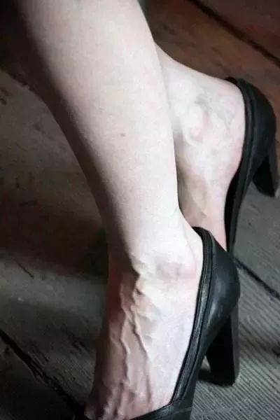 女人手上青筋明顯，究竟是好事還是壞事？真相讓人意外
