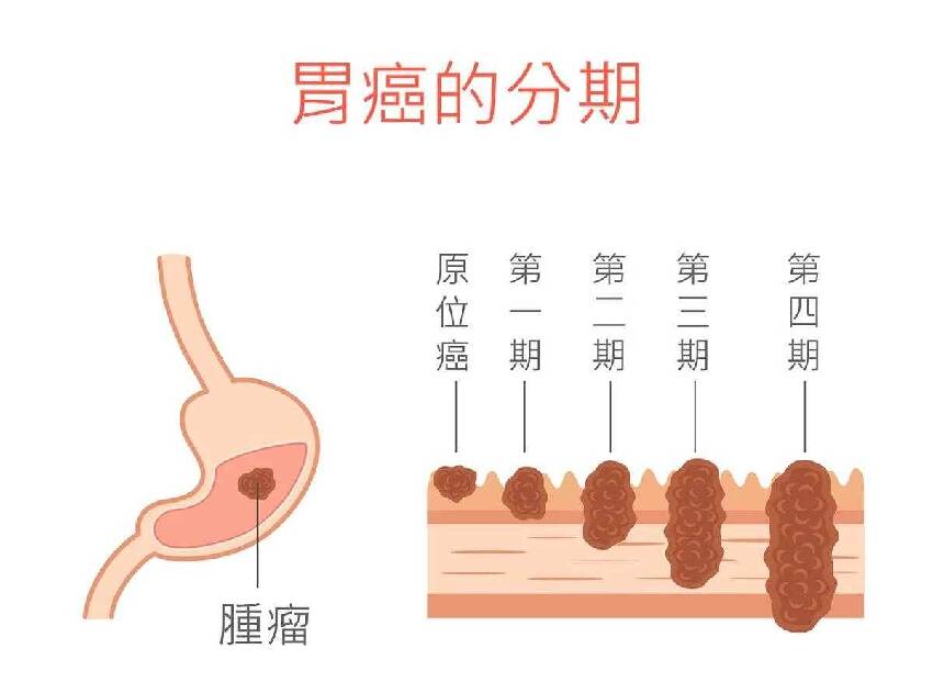 28歲驗出胃癌晚期，父親痛哭：他一年200天都吃！很多人都有這習慣，不改不行