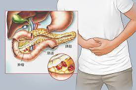 胰腺癌：從確診到死亡僅僅3個月，提醒：4個癥狀，可能是胰腺在求救