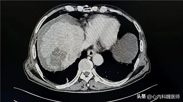 肝癌很會「偽裝」，醫生：皮膚出現3種表現，可能是肝在「呼救」