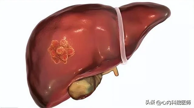 肝癌很會「偽裝」，醫生：皮膚出現3種表現，可能是肝在「呼救」