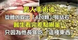 男人手術後從體內取出「420顆」腎結石，醫生看完差點嚇暈！只因為他長年每天吃「這種東西」