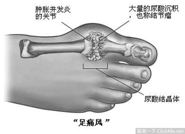 要命的「痛風」終於有改善的方法！居然出乎意料的簡單！