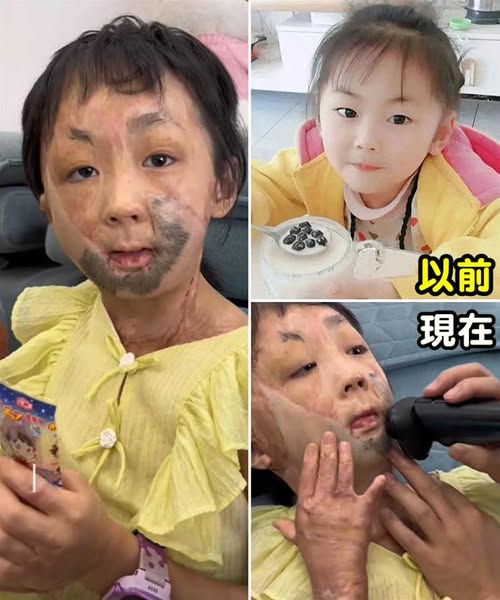 6歲女孩吃火鍋被燒成重傷,13次手術后臉長滿「大鬍子」浴火重生