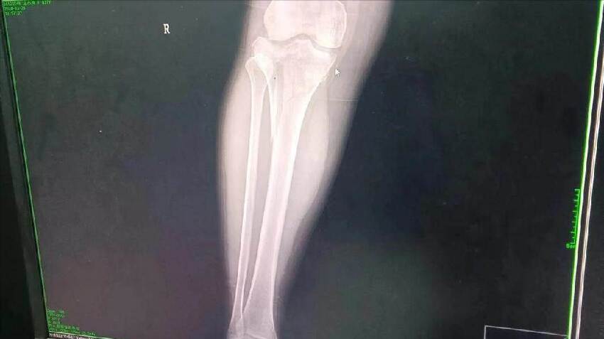 46歲女子「僅僅是骨折」，手術順利竟「突然死亡」，屍體解剖結果醫師都傻眼了