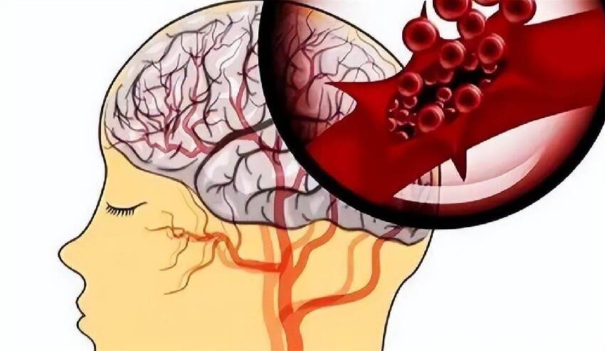 52歲男子突發腦出血走了！醫生怒斥：吃降壓藥時候「沒有注意這3點！」