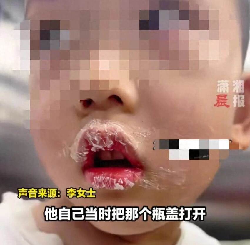 3歲兒子誤將強力膠滴進嘴，媽媽「一個舉動」挽救了孩子，醫生讚：安全有效