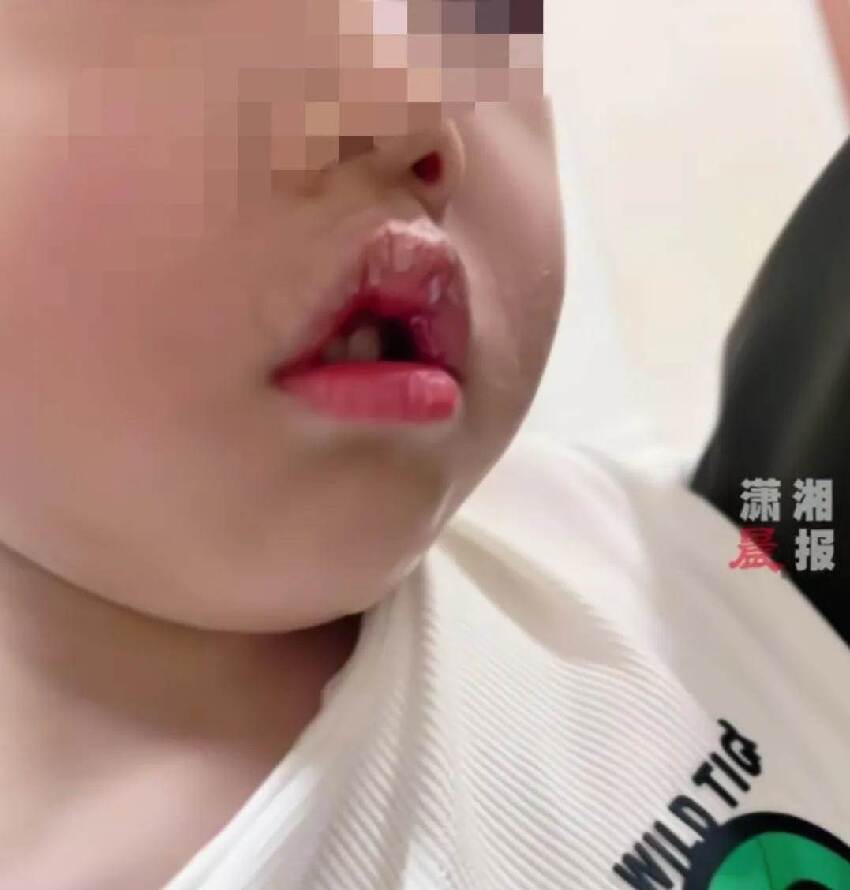 3歲兒子誤將強力膠滴進嘴，媽媽「一個舉動」挽救了孩子，醫生讚：安全有效