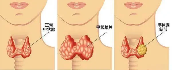 完全沒症狀! 30歲女子「確診甲狀腺癌」她震驚:沒家族病史 醫生示警「出現此徵兆快就醫」