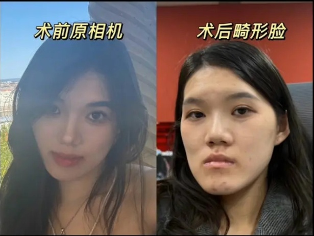 整容變毀容！正妹淚喊「撞臉朱元璋」名醫冷回：這叫洋氣臉