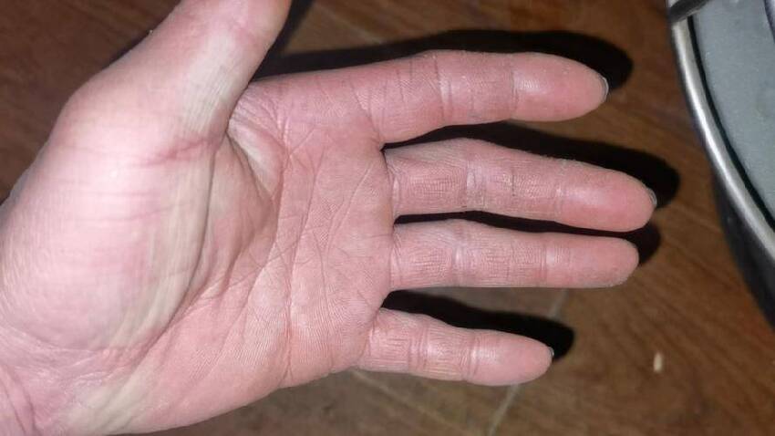HPV感染不只是私處癢！醫生：這兩處長出疙瘩，八成是感染了