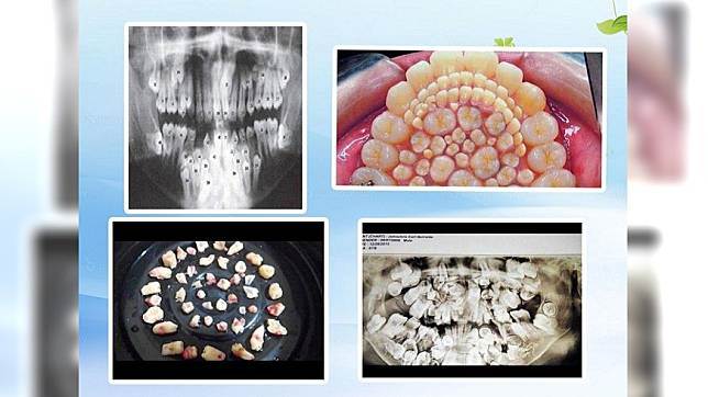 9歲男孩長出「300顆牙」擠滿口腔，看后頭皮發麻，醫生術后直呼罕見：還剩200顆！