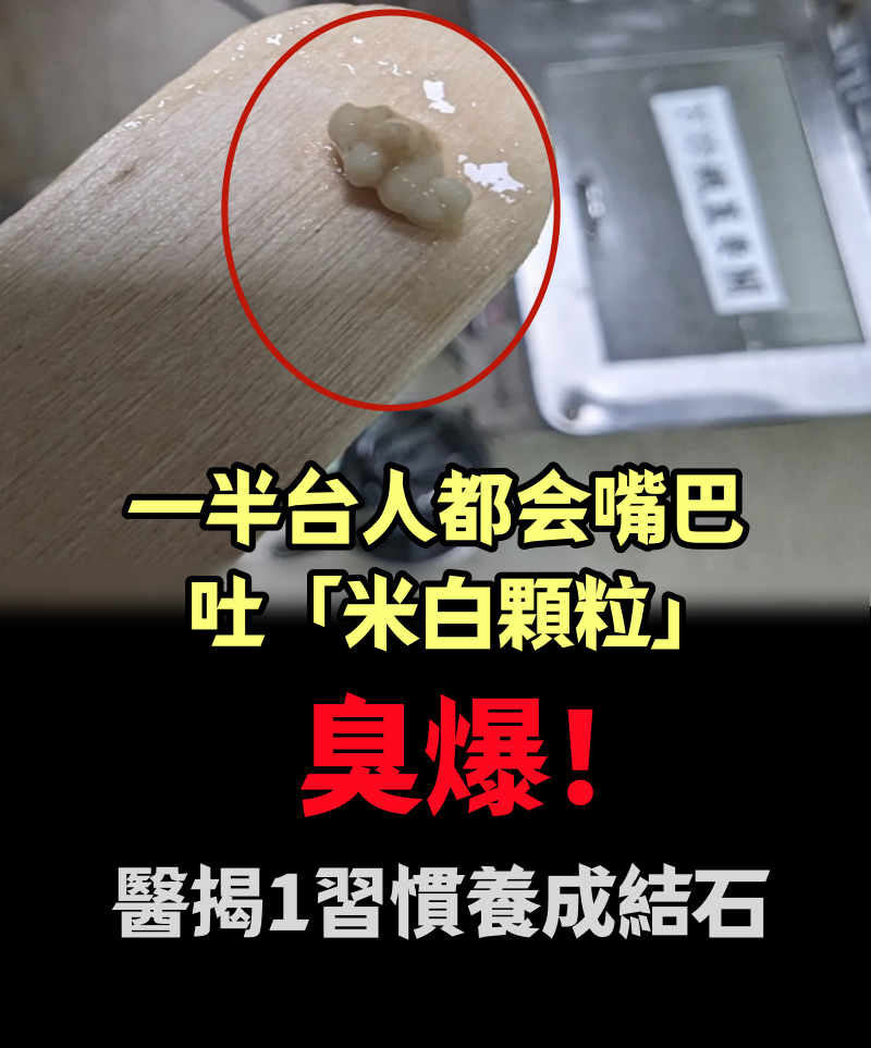 一半台人都會嘴巴吐「米白顆粒」臭爆！  醫揭1習慣養成結石