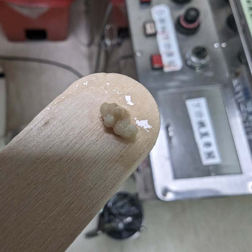 一半台人都會嘴巴吐「米白顆粒」臭爆！  醫揭1習慣養成結石