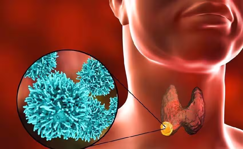 甲狀腺開始癌變,不是看痛不痛! 醫師:若出現6個症狀或已患癌