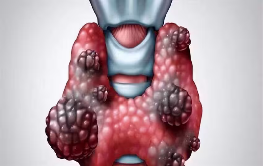 甲狀腺開始癌變，不是看痛不痛！ 醫師：若出現6個症狀或已患癌