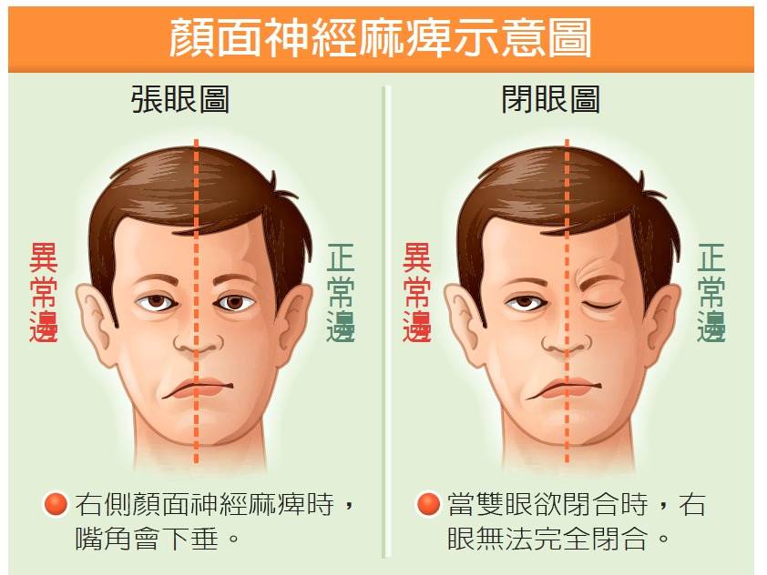 突然臉歪嘴斜！66歲徐乃麟「錄影一半感到不對勁」親曝「危急時刻畫面」警惕：把握黃金治療期！