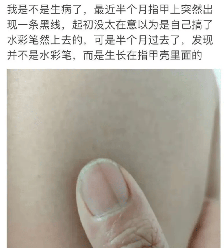 醫生提醒：指甲出現這個變化，可能是癌變！別不當回事！