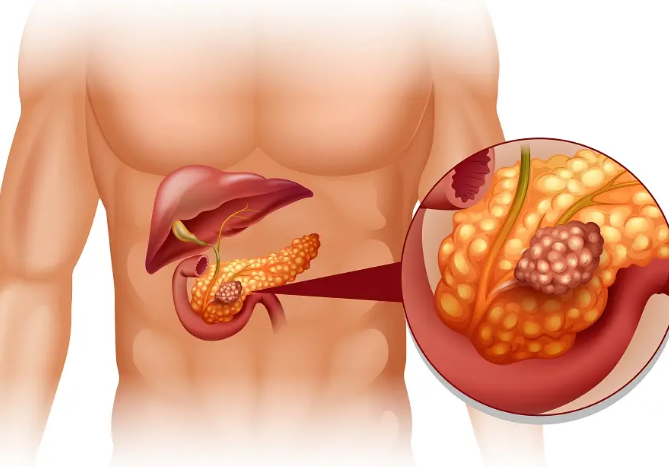 胰腺癌：從確診到死亡僅僅3個月，提醒：4個癥狀，可能是胰腺在求救