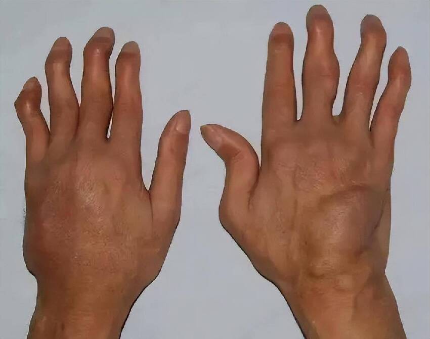 手指是癌症「顯示器」？提醒：若手指出現3個異常，或是癌症來臨