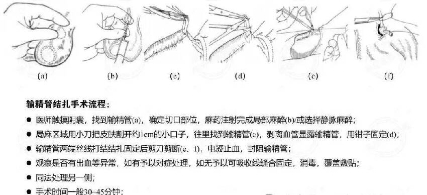 男子結紮3個月後，妻子懷孕了！兩人傻眼…此前已懷孕8次生下3孩