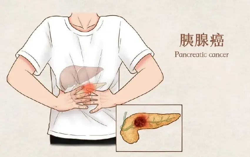 女子每天「大便兩三次」確診胰腺癌!醫生提醒:出現4種異常恐是身體「警報!」