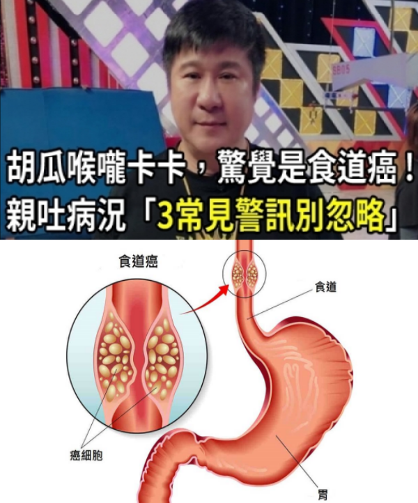 戒不掉壞習慣！胡瓜喉嚨卡卡「驚覺是食道癌」緊急就醫　親吐病況「3常見警訊別忽略」發現大多已晚期！