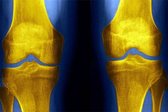 人老腿先老！膝關節疼的人「多吃3種菜」減少發炎　「少做3件事」腿不老人長壽