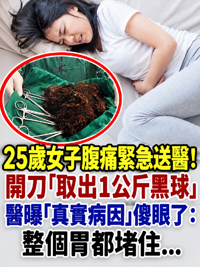 25歲女子腹痛緊急送醫！開刀「取出1公斤黑球」　醫曝「真實病因」傻眼了：整個胃都堵住...