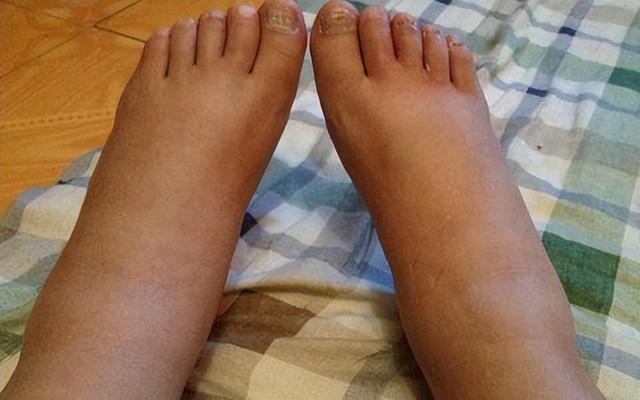 49歲男子尿酸高達760，腎衰離世，醫生惋惜：1種家常菜是「禍根」