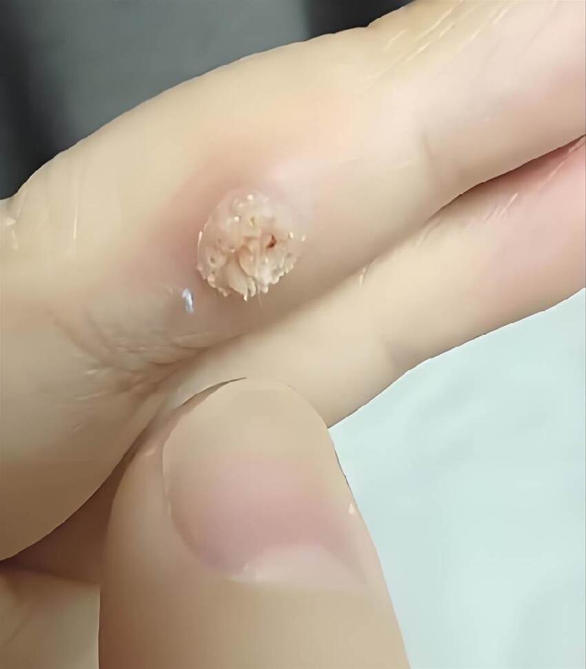 女子旅遊回來手上突現「菜花」硬塊！剪開瞬間嚇懵，醫生急喊：酒店這些「隱形雷區」打死別碰