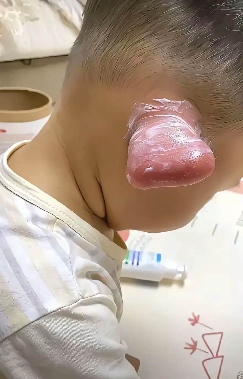 一覺醒來孩子耳朵「腫大3倍」嚇哭媽媽，送醫才知竟是「被牠咬了一小口」醫示警：嚴重恐開刀