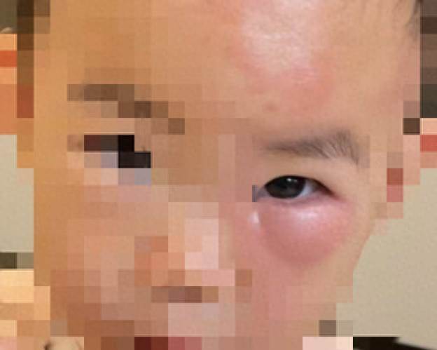 一覺醒來孩子耳朵「腫大3倍」嚇哭媽媽，送醫才知竟是「被牠咬了一小口」醫示警：嚴重恐開刀