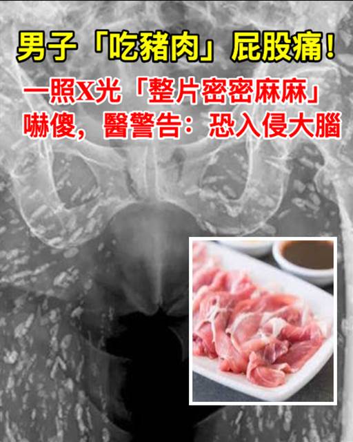 男子「吃豬肉」屁股痛！一照X光「整片密密麻麻」嚇傻，醫警告：恐入侵大腦