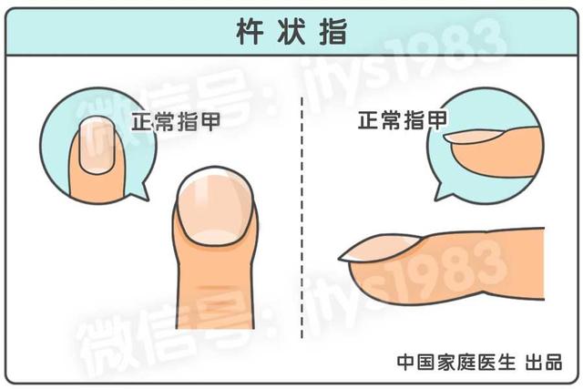 體內有癌，雙手先知！手上出現3個變化，小心是肝癌、肺癌、癌王來臨信號！