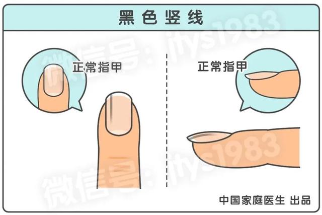 體內有癌，雙手先知！手上出現3個變化，小心是肝癌、肺癌、癌王來臨信號！