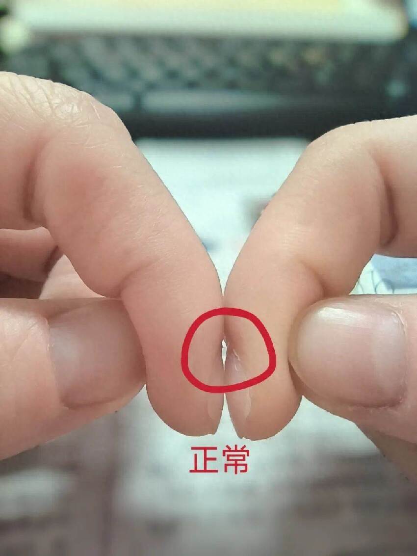 體內有疾，指甲先知！指甲出現這5種表現，請務必重視！尤其是第二種，惡性程度極高