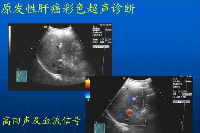 90後夫妻喝桶裝水5年，雙雙確診肝癌，醫生：無知害人不淺